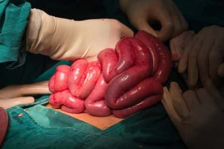 General Surgery Expert Advises On Emergency Appendectomy That Resulted In Sepsis