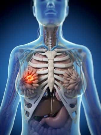 Delayed Diagnosis of Breast Cancer Leads to Distant Internal Organ Metastasis