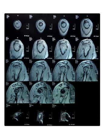 Orthopedic Expert Advises on Worker’s Alleged Injury Claim