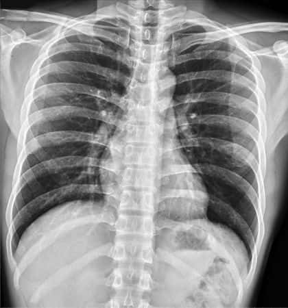 Neurology Expert Witness Opines on Failure to Diagnose Thymoma