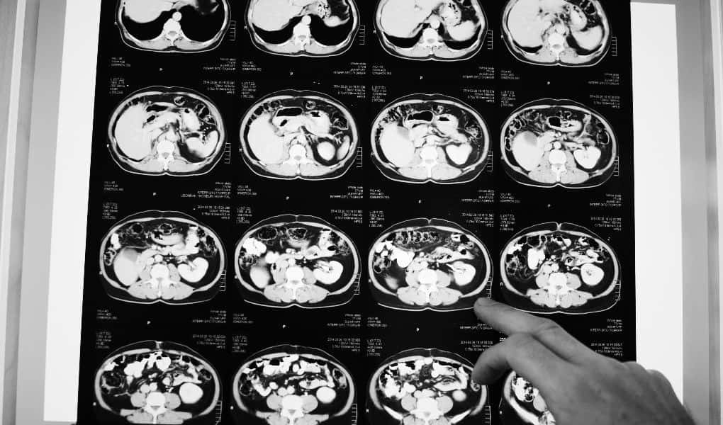 Patient Develops Paralysis Following Brain Surgery