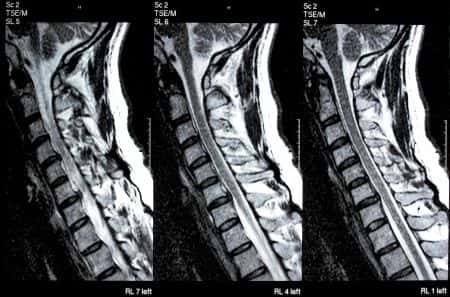 Neurology expert advises on disability benefits for nerve injury