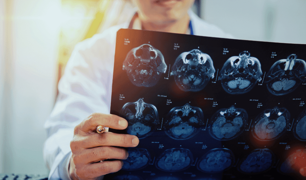 Traumatic Brain Injury Litigation: New Ways to Navigate TBI Cases Using Expert Witnesses