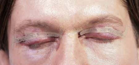 Patient Suffers Partial Vision Loss and Eyelid Retraction After Blepharoplasty