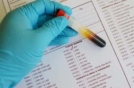 Lack of Monitoring During Psoriasis Treatment Leads to Liver Damage