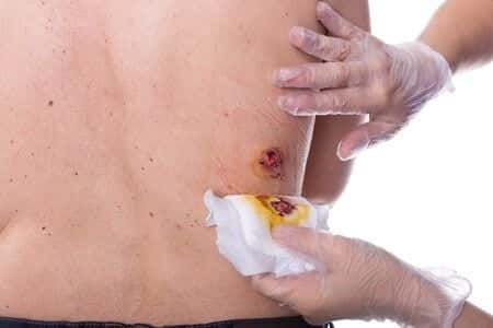 Patient is Killed by Infected Pressure Wounds