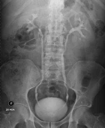 Urologist Prescribes AndroGel to Patient With Prostate Cancer