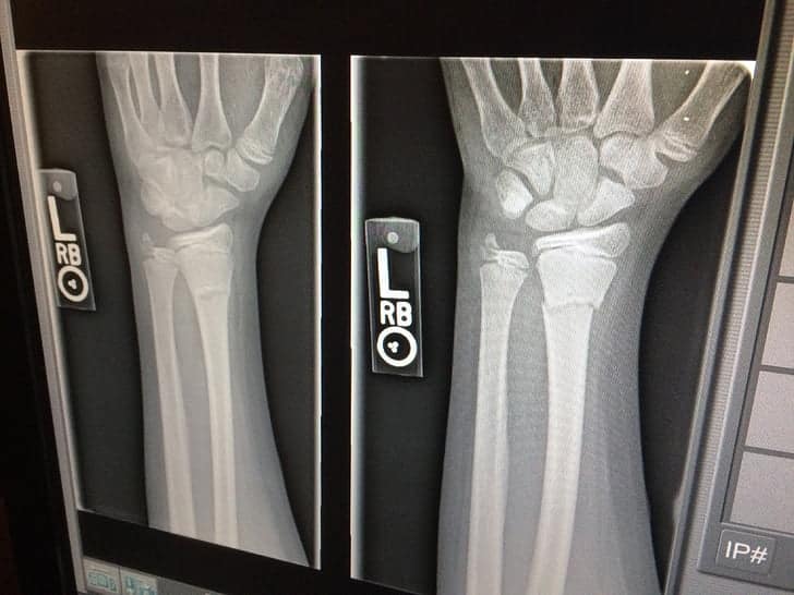 arm xray