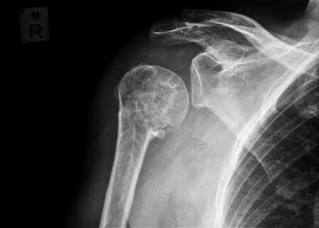 Radiology Expert Opines on Car Accident Injuries