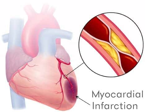 Cardiologist Misses MI Resulting in Fatal Arrhythmia