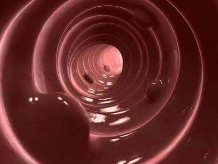 Doctors Fail to Remove Suspicious Polyps