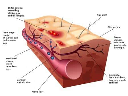 Pediatric Emergency Medicine Expert Witness Advises on Stevens-Johnson Syndrome