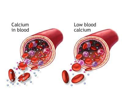 General Surgery Expert Witness Discusses Hypocalcemia in Patient